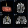 Brain Aneurysm  Ballooning of Artery
